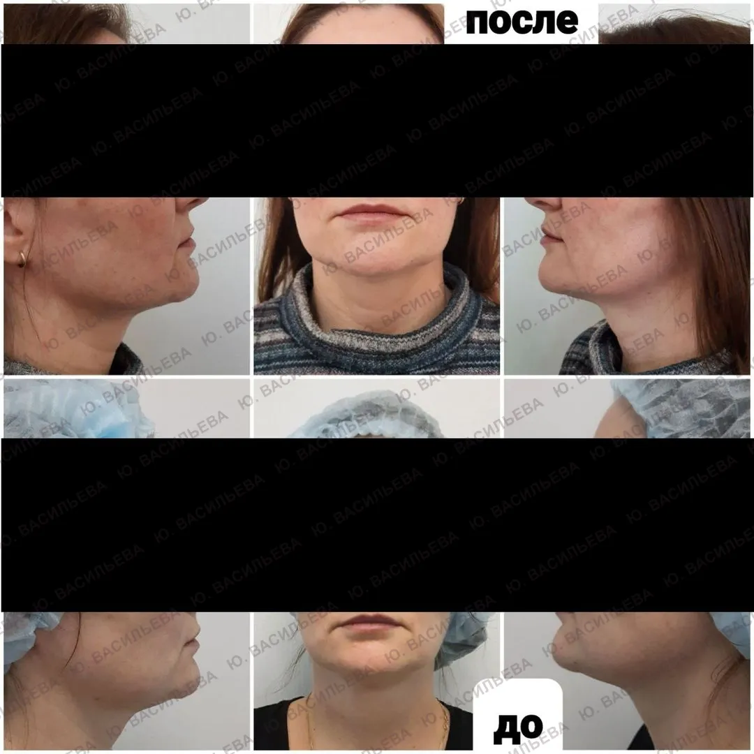 SMAS-лифтинг — фото до и после
